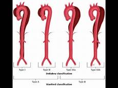 Cross Clamp Type